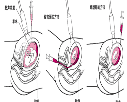代孕费用与成功率解析及黄体破裂术后护理指南
