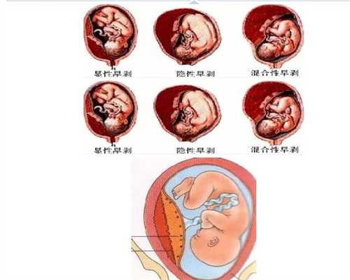 广州供卵试管婴儿中心：怀孕吃虾皮好吗