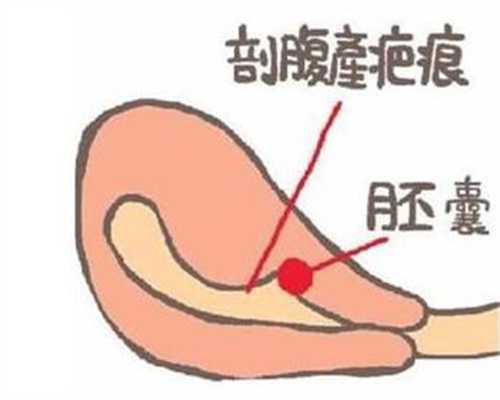 广州代孕网代生孩子价格_宫腔内膜息肉多大需要手术